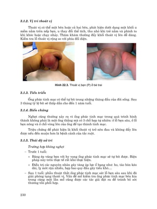 230
3.1.2. VÞ trÝ tho¸t vÞ
Tho¸t vÞ cã thÓ mét bªn hoÆc c¶ hai bªn, ph¸t hiÖn d−íi d¹ng mét khèi u
mÒm n»m trªn nÕp bÑn, u thay ®æi thÓ tÝch, thu nhá khi trÎ n»m vµ ph×nh to
khi khãc hoÆc ch¹y nh¶y. Th¨m kh¸m th−êng ®Èy khèi tho¸t vÞ lªn dÔ dµng.
KiÓm tra lç tho¸t vÞ réng so víi phÝa ®èi diÖn.
H×nh 22.3. Tho¸t vÞ bÑn (P) ë bÐ trai
3.1.3. TiÕn triÓn
èng phóc tinh m¹c cã thÓ tù bÝt trong nh÷ng th¸ng ®Çu cña ®êi sèng. Sau
3 th¸ng tû lÖ bÝt sÏ thÊp dÇn cho ®Õn 1 n¨m tuæi.
3.1.4. BiÕn chøng
NghÑt còng th−êng x¶y ra v× èng phóc tinh m¹c trong qu¸ tr×nh h×nh
thµnh kh«ng ph¶i lµ mét èng th¼ng mµ cã 3 chç hÑp tù nhiªn: ë lç bÑn s©u, ë lç
bÑn n«ng vµ ë chç vßng lªn cña èng ®Ó t¹o thµnh tinh m¹c.
TriÖu chøng ®Ó ph¸t hiÖn lµ khèi tho¸t vÞ trë nªn ®au vµ kh«ng ®Èy lªn
®−îc nÕu ®Õn muén h¬n lµ bÖnh c¶nh cña t¾c ruét.
3.1.5. Th¸i ®é xö trÝ
Tr−êng hîp kh«ng nghÑt
− Tr−íc 1 tuæi:
+ B¨ng Ðp vïng bÑn víi hy väng èng phóc tinh m¹c sÏ tù bÝt ®−îc. BiÖn
ph¸p nµy trªn thùc tÕ rÊt khã thùc hiÖn.
+ §iÒu trÞ c¸c nguyªn nh©n g©y t¨ng ¸p lùc æ bông nh−: ho, t¸o bãn kÐo
dµi, lþ mãt rÆn nhiÒu, hÑp bao quy ®Çu g©y tiÓu khã....
− Sau 1 tuæi: phÉu thuËt th¾t èng phóc tinh m¹c s¸t lç bÑn s©u sau khi ®·
gi¶i phãng t¹ng tho¸t vÞ. VÊn ®Ò mæ kiÓm tra èng phóc tinh m¹c bªn kia
trong cïng mét lÇn mæ còng ®−îc c¸c t¸c gi¶ ®Æt ra ®Ó tr¸nh bá sãt
th−¬ng tæn phèi hîp.
 