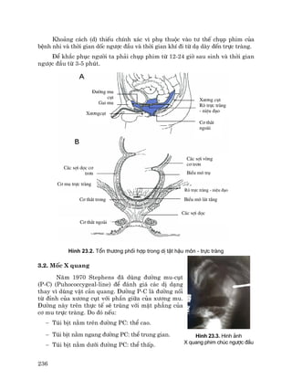 236
Kho¶ng c¸ch (d) thiÕu chÝnh x¸c v× phô thuéc vµo t− thÕ chôp phim cña
bÖnh nhi vµ thêi gian dèc ng−îc ®Çu vµ thêi gian khÝ ®i tõ d¹ dµy ®Õn trùc trµng.
§Ó kh¾c phôc ng−êi ta ph¶i chôp phim tõ 12-24 giê sau sinh vµ thêi gian
ng−îc ®Çu tõ 3-5 phót.
H×nh 23.2. Tæn th−¬ng phèi hîp trong dÞ tËt hËu m«n - trùc trµng
3.2. Mèc X quang
N¨m 1970 Stephens ®· dïng ®−êng mu-côt
(P-C) (Puhococcygeal-line) ®Ó ®¸nh gi¸ c¸c dÞ d¹ng
thay v× dïng vËt c¶n quang. §−êng P-C lµ ®−êng nèi
tõ ®Ønh cña x−¬ng côt víi phÇn gi÷a cña x−¬ng mu.
§−êng nµy trªn thùc tÕ sÏ trïng víi mÆt ph¼ng cña
c¬ mu trùc trµng. Do ®ã nÕu:
− Tói bÞt n»m trªn ®−êng PC: thÓ cao.
− Tói bÞt n»m ngang ®−êng PC: thÓ trung gian.
− Tói bÞt n»m d−íi ®−êng PC: thÓ thÊp.
§−êng mu
côt
Gai mu
X−¬ngcôt
X−¬ng côt
Rß trùc trµng
- niÖu ®¹o
C¬ th¾t
ngoµi
Rß trùc trµng - niÖu ®¹o
BiÓu m« l¸t tÇng
C¸c sîi däc c¬
tr¬n
C¬ mu trùc trµng
C¸c sîi vßng
c¬ tr¬n
BiÓu m« trô
C¬ th¾t trong
C¬ th¾t ngoµi
C¸c sîi däc
H×nh 23.3. Hinh ¶nh
X quang phim chóc ng−îc ®Çu
 
