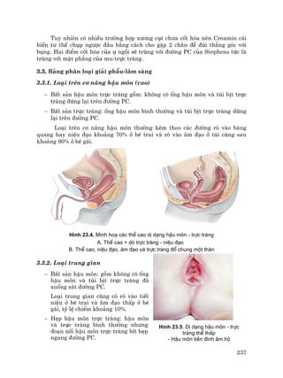 237
Tuy nhiªn cã nhiÒu tr−êng hîp x−¬ng côt ch−a cèt hãa nªn Creamin c¶i
biÕn t− thÕ chôp ng−îc ®Çu b»ng c¸ch cho gËp 2 ch©n ®Ó ®ïi th¼ng gãc víi
bông. Hai ®iÓm cèt hãa cña ô ngåi sÏ trïng víi ®−êng PC cña Stephens tøc lµ
trïng víi mÆt ph¼ng cña mu-trùc trµng.
3.3. B¶ng ph©n lo¹i gi¶i phÉu-l©m sµng
3.3.1. Lo¹i trªn c¬ n©ng hËu m«n (cao)
− BÊt s¶n hËu m«n trùc trµng gåm: kh«ng cã èng hËu m«n vµ tói bÞt trùc
trµng ®øng l¹i trªn ®−êng PC.
− BÊt s¶n trùc trµng: èng hËu m«n b×nh th−êng vµ tói bÞt trùc trµng dõng
l¹i trªn ®−êng PC.
Lo¹i trªn c¬ n©ng hËu m«n th−êng kÌm theo c¸c ®−êng rß vµo bµng
quang hay niÖu ®¹o kho¶ng 70% ë bÐ trai vµ rß vµo ©m ®¹o ë tói cïng sau
kho¶ng 90% ë bÐ g¸i.
H×nh 23.4. Minh ho¹ c¸c thÓ cao dÞ d¹ng hËu m«n - trùc trµng
A. ThÓ cao + dß trùc trµng - niÖu ®¹o
B. ThÓ cao, niÖu ®¹o, ©m ®¹o vµ trùc trµng ®æ chung mét th©n
3.3.2. Lo¹i trung gian
− BÊt s¶n hËu m«n: gåm kh«ng cã èng
hËu m«n vµ tói bÞt trùc trµng ®·
xuèng s¸t ®−êng PC.
Lo¹i trung gian còng cã rß vµo tiÕt
niÖu ë bÐ trai vµ ©m ®¹o thÊp ë bÐ
g¸i, tû lÖ chiÕm kho¶ng 10%.
− HÑp hËu m«n trùc trµng: hËu m«n
vµ trùc trµng b×nh th−êng nh−ng
®o¹n nèi hËu m«n trùc trµng bÝt hÑp
ngang ®−êng PC.
H×nh 23.5. DÞ d¹ng hËu m«n - trùc
trµng thÓ thÊp
- HËu m«n tiÒn ®×nh ©m hé
 