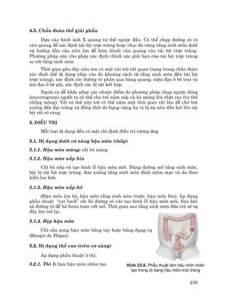 239
4.5. ChÈn ®o¸n thÓ gi¶i phÉu
Dùa vµo h×nh ¶nh X quang t− thÕ ng−îc ®Çu. Cã thÓ chôp ®−êng rß cã
c¶n quang ®Ó x¸c ®Þnh tói bÞt trùc trµng hoÆc chäc dß vïng tÇng sinh m«n d−íi
sù h−íng dÉn cña siªu ©m ®Ó b¬m thuèc c¶n quang vµo tói bÞt trùc trµng.
Ph−¬ng ph¸p nµy cho phÐp x¸c ®Þnh chÝnh x¸c giíi h¹n cña tói bÞt trùc trµng
so víi tÇng sinh m«n.
Thêi gian gÇn ®©y siªu ©m cã mét vµi trß rÊt quan träng trong chÈn ®o¸n
x¸c ®Þnh thÓ dÞ d¹ng (dùa vµo ®o kho¶ng c¸ch tõ tÇng sinh m«n ®Õn tói bÞt
trùc trµng), x¸c ®Þnh c¸c ®−êng rß ph©n qua bµng quang, niÖu ®¹o ë bÐ trai vµ
©m ®¹o ë bÐ g¸i, x¸c ®Þnh c¸c dÞ tËt kÕt hîp.
Ngoµi ra ®Ó kh¾c phôc c¸c nh−îc ®iÓm do ph−¬ng ph¸p chôp ng−îc dßng
(invertogram) ng−êi ta cã thÓ cho trÎ n»m sÊp vµ kª m«ng lªn thËt cao (t− thÕ
chæng m«ng). Víi t− thÕ nµy trÎ cã thÓ n»m mét thêi gian rÊt l©u ®Ó chê h¬i
xuèng ®Õn ®¹i trµng vµ ®ång thêi do bông vïng h¹ vÞ bÞ Ðp nªn dån h¬i lªn tói
bÞt rÊt râ rµng.
5. §iÒu trÞ
Mçi lo¹i dÞ d¹ng ®Òu cã mét chØ ®Þnh ®iÒu trÞ t−¬ng øng
5.1. DÞ d¹ng d−íi c¬ n©ng hËu m«n (thÊp)
5.1.1. HËu m«n mµng: c¾t bá mµng
5.1.2. HËu m«n n¾p kÝn
C¾t bá n¾p vµ t¹o h×nh lç hËu m«n míi. Dïng ®−êng mæ tÇng sinh m«n,
béc lé tói bÞt trùc trµng, ®−a xuèng tÇng sinh m«n ®Ýnh niªm m¹c vµ da theo
kiÓu loa kÌn.
5.1.3. HËu m«n n¾p hë
(HËu m«n ©m hé, hËu m«n tÇng sinh m«n tr−íc, hËu m«n b×u). ¸p dông
phÉu thuËt "cut back” c¾t bá ®−êng rß vµo t¹o h×nh lç hËu m«n míi. Sau khi
xÎ ®−êng rß ®Ó hë hoµn toµn vÕt mæ. Thêi gian sau tÇng sinh m«n ®øa trÎ sÏ tù
®Çy lªn trë l¹i.
5.1.4. HÑp hËu m«n
ChØ cÇn nong hËu m«n b»ng tay hoÆc b»ng dông cô
(Bougie de HÐgar).
5.2. DÞ d¹ng thÓ cao (trªn c¬ n©ng)
¸p dông phÉu thuËt 3 th×:
5.2.1. Th× 1: lµm hËu m«n nh©n t¹o H×nh 23.8. PhÉu thuËt lµm hËu m«n nh©n
t¹o trong dÞ d¹ng hËu m«n-trùc trµng
 