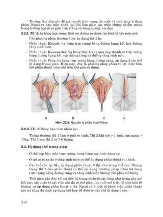240
Th−êng lµm cÊp cøu ®Ó gi¶i quyÕt t×nh tr¹ng t¾c ruét vµ t×nh t¹ng ø ®äng
ph©n. Ngoµi ra hËu m«n nh©n t¹o cßn lµm gi¶m c¸c triÖu chøng nhiÔm trïng
trong tr−êng hîp cã rß gi÷a trùc trµng vµ bµng quang, ©m ®¹o.
5.2.2. Th× 2: h¹ bãng trùc trµng, th¾t c¸c ®−êng rß ph©n, t¹o h×nh lç hËu m«n míi.
C¸c ph−¬ng ph¸p th−êng ®−îc ¸p dông th× 2 lµ:
− PhÉu thuËt Rhoads: h¹ bãng trùc trµng b»ng ®−êng bông kÕt hîp ®−êng
tÇng sinh m«n.
− PhÉu thuËt Kiesewetter: h¹ bãng trùc trµng qua èng thµnh c¬ trùc trµng
b»ng ®−êng bông kÕt hîp ®−êng cïng vµ ®−êng tÇng sinh m«n.
− PhÉu thuËt PÐna: h¹ bãng trùc trµng b»ng ®−êng cïng, ¸p dông ë c¸c thÓ
dÞ d¹ng trung gian. HiÖn nay, ®©y lµ ph−¬ng ph¸p phÉu thuËt ®−îc hÇu
hÕt phÉu thuËt viªn nhi trªn thÕ giíi sö dông.
A B C D
H×nh 23.9. Nguyªn lý phÉu thuËt PÐna
5.2.3. Th× 3: ®ãng hËu m«n nh©n t¹o
Th«ng th−êng th× 1 lµm ë tuæi s¬ sinh. Th× 2 khi trÎ > 1 tuæi, c©n nÆng >
10kg. Th× 3 sau th× 2 tõ 3-6 th¸ng.
5.3. DÞ d¹ng thÓ trung gian
− ë thÓ hÑp hËu m«n trùc trµng: nong b»ng tay hoÆc dông cô
− ë trÎ cã rß ra da ë tÇng sinh m«n cã thÓ ¸p dông phÉu thuËt cut back.
− C¸c thÓ cßn l¹i ®Òu ¸p dông phÉu thuËt 3 th× nh− trong thÓ cao. Nh−ng
trong th× 2 cña phÉu thuËt cã thÓ ¸p dông ph−¬ng ph¸p PÐna h¹ bãng
trùc trµng b»ng ®−êng cïng vµ tÇng sinh m«n kh«ng cÇn ph¶i mæ bông.
Thêi gian gÇn ®©y víi sù tiÕn bé trong phÉu thuËt còng nh− trong g©y mª
håi søc, c¸c phÉu thuËt viªn nhi ®· cã thÓ gi¶m løa tuæi mæ triÖt ®Ó sím h¬n (6
th¸ng) vµ ¸p dông phÉu thuËt 2 th×. Ngoµi ra ë mét sè bÖnh viÖn phÉu thuËt
néi soi còng ®· ®−îc ¸p dông kÕt hîp ®Ó ®iÒu trÞ c¸c thÓ dÞ d¹ng ë cao.
 