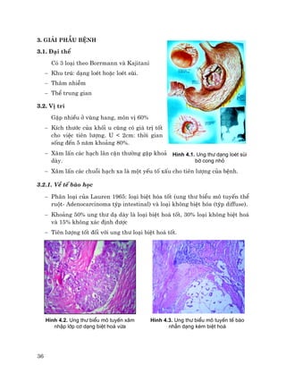 36
3. Gi¶i phÉu bÖnh
3.1. §¹i thÓ
Cã 3 lo¹i theo Borrmann vµ Kajitani
− Khu tró: d¹ng loÐt hoÆc loÐt sïi.
− Th©m nhiÔm
− ThÓ trung gian
3.2. VÞ trÝ
GÆp nhiÒu ë vïng hang, m«n vÞ 60%
− KÝch th−íc cña khèi u còng cã gi¸ trÞ tèt
cho viÖc tiªn l−îng. U < 2cm: thêi gian
sèng ®Õn 5 n¨m kho¶ng 80%.
− X©m lÊn c¸c h¹ch l©n cËn th−êng gÆp kho¶ng 60% tr−êng hîp ung th− d¹
dµy.
− X©m lÊn c¸c chuçi h¹ch xa lµ mét yÕu tè xÊu cho tiªn l−îng cña bÖnh.
3.2.1. VÒ tÕ bµo häc
− Ph©n lo¹i cña Lauren 1965: lo¹i biÖt hãa tèt (ung th− biÓu m« tuyÕn thÓ
ruét- Adenocarcinoma týp intestinal) vµ lo¹i kh«ng biÖt hãa (týp diffuse).
− Kho¶ng 50% ung th− d¹ dµy lµ lo¹i biÖt ho¸ tèt, 30% lo¹i kh«ng biÖt ho¸
vµ 15% kh«ng x¸c ®Þnh ®−îc
− Tiªn l−îng tèt ®èi víi ung th− lo¹i biÖt ho¸ tèt.
H×nh 4.2. Ung th− biÓu m« tuyÕn x©m
nhËp líp c¬ d¹ng biÖt ho¸ võa
H×nh 4.3. Ung th− biÓu m« tuyÕn tÕ bµo
nhÉn d¹ng kÐm biÖt ho¸
H×nh 4.1. Ung th− d¹ng loÐt sïi
bê cong nhá
 
