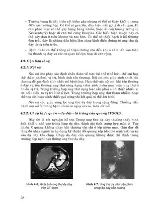 38
− Tr−íng bông lµ dÊu hiÖu rÊt hiÕm gÆp nh−ng cã thÓ sê thÊy khèi u trong
50% c¸c tr−êng hîp. Cã thÓ cã gan lín, dÊu hiÖu nµy gîi ý di c¨n gan. Di
c¨n phóc m¹c cã thÓ g©y bông b¸ng nhiÒu, hoÆc di c¨n buång trøng (u
Krukenberg) hoÆc di c¨n tói cïng Douglas. C¸c biÓu hiÖn muén nµy cã
thÓ g©y ®au ë tiÓu khung vµ t¸o bãn. Cã thÓ sê thÊy h¹ch ë hè th−îng
®ßn tr¸i, ®©y lµ nh÷ng dÊu hiÖu l©m sµng kinh ®iÓn chøng tá ung th− d¹
dµy ®ang tiÕn triÓn.
− BÖnh nh©n cã thÓ kh«ng cã triÖu chøng cho ®Õn khi u x©m lÊn vµo toµn
bé thµnh d¹ dµy vµ c¸c c¬ quan kÕ cËn hoÆc di c¨n réng.
4.2. CËn l©m sµng
4.2.1. Néi soi
Néi soi cho phÐp x¸c ®Þnh chÈn ®o¸n vÒ mÆt ®¹i thÓ (thÓ loÐt, thÓ sïi hay
thÓ th©m nhiÔm), vÞ trÝ, h×nh ¶nh tæn th−¬ng. Néi soi cßn gióp sinh thiÕt tæn
th−¬ng ®Ó x¸c ®Þnh tÝnh chÊt m« bÖnh häc. H¹n chÕ cña néi soi: khi tæn th−¬ng
ë ®¸y vÞ, tæn th−¬ng ung th− n«ng d¹ng viªm x−íc niªm m¹c hoÆc ung th− ë
nhiÒu vÞ trÝ. Trong tr−êng hîp ung th− d¹ng loÐt cÇn ph¶i sinh thiÕt nhiÒu vÞ
trÝ, tèi thiÓu 15 vÞ trÝ ë bê æ loÐt. Trong tr−êng hîp ung th− th©m nhiÔm hoÆc
thÓ teo ®Ðt hoÆc sinh thiÕt qu¸ n«ng th× kÕt qu¶ cã thÓ ©m tÝnh.
Néi soi cßn gióp sµng läc ung th− d¹ dµy trong céng ®ång. Th−êng tiÕn
hµnh néi soi ë nh÷ng bÖnh nh©n cã nguy c¬ cao, trªn 40 tuæi.
4.2.2. Chôp thùc qu¶n – d¹ dµy - t¸ trµng c¶n quang (TOGD)
§©y chØ lµ xÐt nghiÖm hç trî. Trong ung th− d¹ dµy th−êng thÊy h×nh
¶nh khèi u nh« vµo trong lßng d¹ dµy, ®¸nh gi¸ t×nh tr¹ng hÑp m«n vÞ. Tuy
nhiªn X quang kh«ng nh¹y khi th−¬ng tæn chØ ë líp niªm m¹c. GÇn ®©y ®Ó
t¨ng ®é nh¹y ng−êi ta ¸p dông kü thuËt ®èi quang kÐp (double contrast) vµ Ðp
vµo d¹ dµy khi chôp. Chôp d¹ dµy c¶n quang kh«ng ®−îc chØ ®Þnh trong
tr−êng hîp nghi ngê thñng ung th− d¹ dµy.
H×nh 4.6. H×nh ¶nh ung th− d¹ dµy
trªn CT scan
H×nh 4.7. Ung th− d¹ dµy trªn phim
chôp d¹ dµy c¶n quang
 