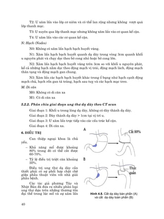 40
T2: U x©m lÊn vµo líp c¬ niªm vµ cã thÓ lan réng nh−ng kh«ng v−ît qu¸
líp thanh m¹c.
T3: U xuyªn qua líp thanh m¹c nh−ng kh«ng x©m lÊn vµo c¬ quan kÕ cËn.
T4: U x©m lÊn vµo c¸c c¬ quan kÕ cËn.
N: H¹ch (Nodes)
N0: Kh«ng cã x©m lÊn h¹ch b¹ch huyÕt vïng.
N1: X©m lÊn h¹ch b¹ch huyÕt quanh d¹ dµy trong vßng 3cm quanh khèi
u nguyªn ph¸t vµ ch¹y däc theo bê cong nhá hoÆc bê cong lín.
N2: X©m lÊn h¹ch b¹ch huyÕt vïng trªn 3cm so víi khèi u nguyªn ph¸t,
kÓ c¶ nh÷ng h¹ch n»m däc theo ®éng m¹ch vÞ tr¸i, ®éng m¹ch l¸ch, ®éng m¹ch
th©n t¹ng vµ ®éng m¹ch gan chung.
N3: X©m lÊn c¸c h¹ch b¹ch huyÕt kh¸c trong æ bông nh− h¹ch c¹nh ®éng
m¹ch chñ, h¹ch rèn gan t¸ trµng, h¹ch sau tuþ vµ c¸c h¹ch m¹c treo.
M: Di c¨n
M0: Kh«ng cã di c¨n xa
M1: Cã di c¨n xa
5.2.2. Ph©n chia giai ®o¹n ung th− d¹ dµy theo CT scan
Giai ®o¹n 1: Khèi u trong lßng d¹ dµy, kh«ng cã dµy thµnh d¹ dµy.
Giai ®o¹n 2: Dµy thµnh d¹ dµy > 1cm t¹i vÞ trÝ u.
Giai ®o¹n 3: U x©m lÊn trùc tiÕp vµo c¸c cÊu tróc kÕ cËn.
Giai ®o¹n 4: Di c¨n xa.
6. §iÒu trÞ
Can thiÖp ngo¹i khoa lµ chñ
yÕu.
− Kh¶ n¨ng mæ ®−îc kho¶ng
80% trong ®ã cã thÓ c¾t ®−îc
60-70%.
− Tû lÖ ®iÒu trÞ triÖt c¨n kho¶ng
50%.
§iÒu trÞ ung th− d¹ dµy cÇn
thiÕt ph¶i cã sù phèi hîp chÆt chÏ
gi÷a phÉu thuËt viªn víi nhµ gi¶i
phÉu bÖnh.
C¸c t¸c gi¶ ph−¬ng T©y vµ
NhËt B¶n ®· ®−a ra nhiÒu ph©n lo¹i
ung th− dùa trªn nh÷ng th−¬ng tæn
®¹i thÓ trong lóc mæ vµ sù x©m lÊn H×nh 4.8. C¾t d¹ dµy b¸n phÇn (A)
vµ c¾t d¹ dµy toµn phÇn (B)
 