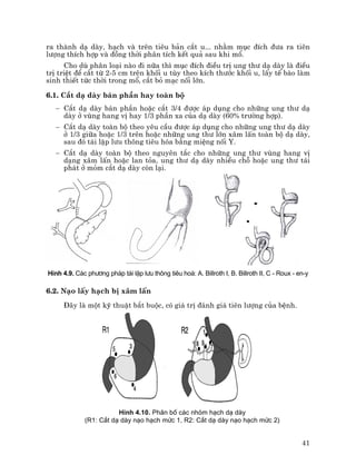 41
ra thµnh d¹ dµy, h¹ch vµ trªn tiªu b¶n c¾t u... nh»m môc ®Ých ®−a ra tiªn
l−îng thÝch hîp vµ ®ång thêi ph©n tÝch kÕt qu¶ sau khi mæ.
Cho dï ph©n lo¹i nµo ®i n÷a th× môc ®Ých ®iÒu trÞ ung th− d¹ dµy lµ ®iÒu
trÞ triÖt ®Ó c¾t tõ 2-5 cm trªn khèi u tïy theo kÝch th−íc khèi u, lÊy tÕ bµo lµm
sinh thiÕt tøc thêi trong mæ, c¾t bá m¹c nèi lín.
6.1. C¾t d¹ dµy b¸n phÇn hay toµn bé
− C¾t d¹ dµy b¸n phÇn hoÆc c¾t 3/4 ®−îc ¸p dông cho nh÷ng ung th− d¹
dµy ë vïng hang vÞ hay 1/3 phÇn xa cña d¹ dµy (60% tr−êng hîp).
− C¾t d¹ dµy toµn bé theo yªu cÇu ®−îc ¸p dông cho nh÷ng ung th− d¹ dµy
ë 1/3 gi÷a hoÆc 1/3 trªn hoÆc nh÷ng ung th− lín x©m lÊn toµn bé d¹ dµy,
sau ®ã t¸i lËp l−u th«ng tiªu hãa b»ng miÖng nèi Y.
− C¾t d¹ dµy toµn bé theo nguyªn t¾c cho nh÷ng ung th− vïng hang vÞ
d¹ng x©m lÊn hoÆc lan táa, ung th− d¹ dµy nhiÒu chç hoÆc ung th− t¸i
ph¸t ë mám c¾t d¹ dµy cßn l¹i.
H×nh 4.9. C¸c ph−¬ng ph¸p t¸i lËp l−u th«ng tiªu ho¸: A. Billroth I, B. Billroth II, C - Roux - en-y
6.2. N¹o lÊy h¹ch bÞ x©m lÊn
§©y lµ mét kü thuËt b¾t buéc, cã gi¸ trÞ ®¸nh gi¸ tiªn l−îng cña bÖnh.
H×nh 4.10. Ph©n bè c¸c nhãm h¹ch d¹ dµy
(R1: C¾t d¹ dµy n¹o h¹ch møc 1, R2: C¾t d¹ dµy n¹o h¹ch møc 2)
 