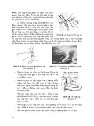 52
Oddi, chÝt hÑp ®−êng mËt, sái mËt kÌm theo
nang èng mËt chñ. Ngoµi ra sái mËt trong
gan r¶i r¸c nhiÒu n¬i, nhiÒu sái hoÆc sái mËt
®· ph¶i mæ ®i mæ l¹i nhiÒu lÇn.
Cã nhiÒu ph−¬ng ph¸p nèi mËt-tiªu ho¸
kh¸c nhau, viÖc lùa chän ph−¬ng ph¸p nµy
tuú thuéc vµo bÖnh lý còng nh− thãi quen cña
phÉu thuËt viªn. Ph−¬ng ph¸p ®¬n gi¶n nhÊt
lµ nèi èng mËt chñ-t¸ trµng, tuy nhiªn ®· cã
nhiÒu nh−îc ®iÓm: ®Ó l¹i tói bÞt èng mËt chñ
phÝa d−íi lµ nguyªn nh©n cña l¾ng ®äng sái
vµ ung th− ho¸, nhiÔm trïng ng−îc dßng. Xu h−íng hiÖn nay lµ nèi èng mËt
chñ-hçng trµng theo ph−¬ng ph¸p Roux-en-Y víi nhiÒu −u ®iÓm: tr¸nh ®−îc
nhiÔm trïng ng−îc dßng, kh«ng cã tói bÞt èng mËt chñ.
H×nh 5.10. Dïng dông cô lÊy sái cßn sãt
qua èng ch÷ T
H×nh 5.11. Chôp ®−êng mËt kiÓm tra qua
èng ch÷ T
− Ph−¬ng ph¸p më réng c¬ Oddi qua ®−êng t¸
trµng (cßn ®−îc gäi lµ nèi èng mËt chñ - t¸
trµng bªn trong).
− Ph−¬ng ph¸p nèi èng mËt chñ t¸ trµng kiÓu
miÖng nèi bªn bªn: dÔ lµm, Ýt biÕn chøng
nh−ng cã nguy c¬ nhiÔm trïng ng−îc dßng do
c¸c vi khuÈn ®−êng ruét, giun, thøc ¨n trµo
lªn ®−êng mËt.
− Ph−¬ng ph¸p nèi èng mËt chñ - hçng trµng
kiÓu Ronal-Smith: ®−îc ¸p dông trong tr−êng
hîp èng mËt chñ bÞ chÌn Ðp vµ u ®Çu tuþ g©y
hÑp t¸ trµng.
− Ph−¬ng ph¸p nèi èng mËt chñ – hçng trµng kiÓu Roux en Y: cã −u ®iÓm
h¹n chÕ tû lÖ nhiÔm trïng ®−êng mËt ng−îc dßng do trµo ng−îc.
− PhÉu thuËt c¾t ph©n thuú + h¹ ph©n thïy gan trong ®iÒu trÞ sái gan.
H×nh 5.9. Më èng mËt chñ lÊy sái
H×nh 12. Nèi mËt ruét
Roux-en-Y
 