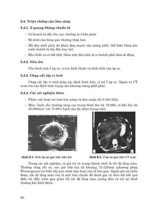 60
5.4. TriÖu chøng cËn l©m sµng
5.4.1. X quang kh«ng chuÈn bÞ
− C¬ hoµnh bÞ ®Èy lªn cao, th−êng lµ ë bªn ph¶i.
− Bê d−íi cña bãng gan th−êng thÊp h¬n
− Mê ®¸y phæi ph¶i do ph¶n øng m¹nh cña mµng phæi, thÓ hiÖn b»ng gãc
s−ên hoµnh bÞ lÊp ®Çy hay mê.
− Khi chiÕu ta cã thÓ thÊy thªm mét dÊu hiÖu lµ c¬ hoµnh ph¶i kÐm di ®éng.
5.4.2. Siªu ©m
Cho h×nh ¶nh æ ¸p xe, vÞ trÝ, kÝch th−íc vµ tÝnh chÊt cña ¸p xe.
5.4.3. Chôp c¾t líp vi tÝnh
Chôp c¾t líp vi tÝnh gióp x¸c ®Þnh h×nh ¶nh, vÞ trÝ æ ¸p xe. Ngoµi ra CT
scan cßn x¸c ®Þnh t×nh tr¹ng cña khoang mµng phæi ph¶i.
5.4.4. C¸c xÐt nghiÖm kh¸c
− Ph©n: cÊy hoÆc soi t−¬i t×m amÝp vµ kÐn amÝp rÊt Ýt khi thÊy.
− M¸u: b¹ch cÇu th−êng t¨ng cao trung b×nh lªn tíi 10.000, cã khi lªn tíi
20.000mm3
víi 75-80% b¹ch cÇu ®a nh©n trung tÝnh.
H×nh 6.1. H×nh ¸p xe gan trªn siªu ©m H×nh 6.2. æ ¸p xe gan trªn CT scan
Trong c¸c xÐt nghiÖm, cã gi¸ trÞ vµ trung thµnh nhÊt lµ tèc ®é l¾ng m¸u.
Th−êng t¨ng rÊt râ, sau giê thø hai tõ kho¶ng 75-125mm (ph−¬ng ph¸p
Westergreen) nã biÓu thÞ qu¸ tr×nh hñy ho¹i cña tÕ bµo gan. Ngoµi gi¸ trÞ chÈn
®o¸n, tèc ®é l¾ng m¸u cßn lµ mét tiªu chuÈn ®Ó ®¸nh gi¸ vµ theo dâi kÕt qu¶
®iÒu trÞ. Khi viªm gan gi¶m th× tèc ®é l¾ng m¸u xuèng dÇn vµ trë l¹i b×nh
th−êng khi khái bÖnh.
 