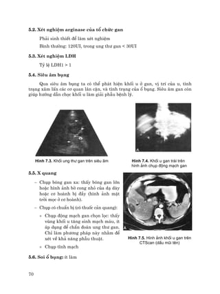 70
5.2. XÐt nghiÖm arginase cña tæ chøc gan
Ph¶i sinh thiÕt ®Ó lµm xÐt nghiÖm
B×nh th−êng: 120UI, trong ung th− gan < 30UI
5.3. XÐt nghiÖm LDH
Tû lÖ LDH1 > 1
5.4. Siªu ©m bông
Qua siªu ©m bông ta cã thÓ ph¸t hiÖn khèi u ë gan, vÞ trÝ cña u, t×nh
tr¹ng x©m lÊn c¸c c¬ quan l©n cËn, vµ t×nh tr¹ng cña æ bông. Siªu ©m gan cßn
gióp h−íng dÉn chäc khèi u lµm gi¶i phÉu bÖnh lý.
H×nh 7.3. Khèi ung th− gan trªn siªu ©m H×nh 7.4. Khèi u gan tr¸i trªn
h×nh ¶nh chôp ®éng m¹ch gan
5.5. X quang
− Chôp bãng gan xa: thÊy bãng gan lín
hoÆc h×nh ¶nh bê cong nhá cña d¹ dµy
hoÆc c¬ hoµnh bÞ ®Çy (h×nh ¶nh mÆt
trêi mäc ë c¬ hoµnh).
− Chôp cã chuÈn bÞ (cã thuèc c¶n quang):
+ Chôp ®éng m¹ch gan chän läc: thÊy
vïng khèi u t¨ng sinh m¹ch m¸u, Ýt
¸p dông ®Ó chÈn ®o¸n ung th− gan.
ChØ lµm ph−¬ng ph¸p nµy nh»m ®Ó
xÐt vÒ kh¶ n¨ng phÉu thuËt.
+ Chôp tÜnh m¹ch
5.6. Soi æ bông: Ýt lµm
H×nh 7.5. H×nh ¶nh khèi u gan trªn
CTScan (dÊu mòi tªn)
 
