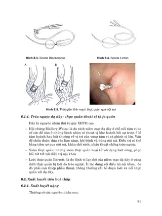 81
H×nh 8.3. Sonde Blackemore H×nh 8.4. Sonde Linton
H×nh 8.5. Th¾t gi·n tÜnh m¹ch thùc qu¶n qua néi soi
6.1.4. Trµo ng−îc d¹ dµy - thùc qu¶n-tho¸t vÞ thùc qu¶n
§©y lµ nguyªn nh©n thø t− g©y XHTH cao.
− Héi chøng Mallory-Weiss: lµ do r¸ch niªm m¹c d¹ dµy ë chç nèi t©m vÞ do
cè søc ®Ó n«n ë nh÷ng bÖnh nh©n cã tho¸t vÞ khe hoµnh bëi sù tr−ît ë lç
t©m hoµnh hay bÊt th−êng vÒ vÞ trÝ cña vïng t©m vÞ vµ ph×nh vÞ lín. VÊn
®Ò chÈn ®o¸n: dùa vµo l©m sµng, hái bÖnh vµ dïng néi soi. §iÒu trÞ cã thÓ
b»ng tiªm x¬ qua néi soi, kh©u chç r¸ch, phÉu thuËt chèng trµo ng−îc.
− Viªm thùc qu¶n: nh÷ng viªm thùc qu¶n ho¹i tö víi d¹ng loÐt n«ng, phôc
håi rÊt tèt víi ®iÒu trÞ néi khoa
− LoÐt thùc qu¶n Barrett: lµ do ®Þnh vÞ l¹c chç cña niªm m¹c d¹ dµy ë vïng
d−íi thùc qu¶n bÞ loÐt do trµo ng−îc. Ýt t¸c dông víi ®iÒu trÞ néi khoa, do
®ã ph¶i can thiÖp phÉu thuËt, th«ng th−êng c¾t bá ®o¹n loÐt vµ nèi thùc
qu¶n víi d¹ dµy.
6.2. XuÊt huyÕt tiªu ho¸ thÊp
6.2.1. XuÊt huyÕt nÆng
Th−êng cã c¸c nguyªn nh©n sau:
 