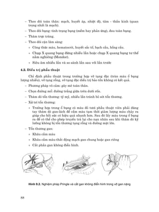 88
− Theo dâi toµn th©n: m¹ch, huyÕt ¸p, nhiÖt ®é, t©m - thÇn kinh (quan
träng nhÊt lµ m¹ch).
− Theo dâi bông: t×nh tr¹ng bông (mÒm hay ph¶n øng), ®au toµn bông.
− Th¨m trùc trµng.
− Theo dâi cËn l©m sµng:
+ C«ng thøc m¸u, hematocrit, huyÕt s¾c tè, b¹ch cÇu, hång cÇu.
+ Chôp X quang bông ®øng nhiÒu lÇn hoÆc chôp X quang bông t− thÕ
n»m nghiªng (Mondor).
+ Siªu ©m nhiÒu lÇn vµ so s¸nh lÇn sau víi lÇn tr−íc
4.2. §iÒu trÞ phÉu thuËt
ChØ ®Þnh phÉu thuËt trong tr−êng hîp vì t¹ng ®Æc (trµn m¸u æ bông
l−îng nhiÒu), vì t¹ng rçng, vì t¹ng ®Æc diÒu trÞ b¶o tån kh«ng cã kÕt qu¶.
− Ph−¬ng ph¸p v« c¶m: g©y mª toµn th©n.
− Chän ®−êng mæ: ®−êng tr¾ng gi÷a trªn d−íi rèn.
− Th¨m dß tæn th−¬ng: tû mû, nhiÒu lÇn tr¸nh bá sãt tæn th−¬ng.
− Xö trÝ tæn th−¬ng:
+ Tr−êng hîp trong æ bông cã m¸u ®á t−¬i phÉu thuËt viªn ph¶i dïng
tay th¨m dß gan-l¸ch ®Ó cÇm m¸u t¹m thêi gi¶m l−îng m¸u ch¶y ra
gióp cho håi søc cã hiÖu qu¶ nhanh h¬n. Sau ®ã lÊy m¸u trong æ bông
ra ®Ó cã thÓ cho phÐp truyÒn tr¶ l¹i cho n¹n nh©n sau khi th¨m dß kü
l−ìng kh«ng bÞ tæn th−¬ng t¹ng rçng vµ ®−êng mËt lín.
− Tæn th−¬ng gan:
+ Kh©u cÇm m¸u
+ Kh©u cÇm m¸u-th¾t ®éng m¹ch gan chung hoÆc gan riªng
+ C¾t phÇn gan kh«ng ®iÓn h×nh.
H×nh 9.2. NghiÖm ph¸p Pringle vµ c¾t gan kh«ng ®iÓn h×nh trong vì gan nÆng
 