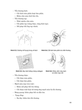 89
− Tæn th−¬ng l¸ch:
+ C¾t l¸ch toµn phÇn hoÆc b¸n phÇn.
+ Kh©u cÇm m¸u l¸ch b¶o tån.
− Tæn th−¬ng tôy:
+ NhÐt mÌche cÇm m¸u.
+ C¾t phÇn tôy (vïng thËn, vïng ®u«i tôy).
+ Nèi phôc håi èng tôy chÝnh.
H×nh 9.3. §−êng më bông trong vì l¸ch H×nh 9.4. C¾t l¸ch b¸n phÇn do chÊn th−¬ng
H×nh 9.5. Bäc l¸ch b»ng mµng collagen H×nh 9.6. Kh©u cÇm m¸u l¸ch
cã chÌn m¹c nèi
− Tæn th−¬ng thËn:
+ C¾t thËn toµn phÇn.
+ C¾t thËn b¸n phÇn.
− M¹ch m¸u m¹c treo ruét :
+ Kh©u nèi phôc håi l−u th«ng.
+ C¾t ®o¹n ruét ho¹i tö t−¬ng øng m¹ch m¸u bÞ tæn th−¬ng.
− Bµng quang: kh©u phôc håi vµ dÉn l−u.
− T¹ng rçng:
+ D¹ dµy: kh©u kÝn tæn th−¬ng.
 