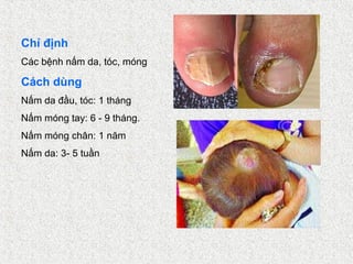 Chỉ định
Các bệnh nấm da, tóc, móng

Cách dùng
Nấm da đầu, tóc: 1 tháng
Nấm móng tay: 6 - 9 tháng.
Nấm móng chân: 1 năm
Nấm da: 3- 5 tuần
 