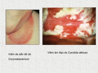 Viêm âm đạo do Candida albican
Viêm da sẩn đỏ do
Corynebacterium
 
