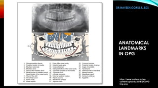 Lablled Opg Orthopantomogram OPG and Dental Panoromic Radiography | PPTX
