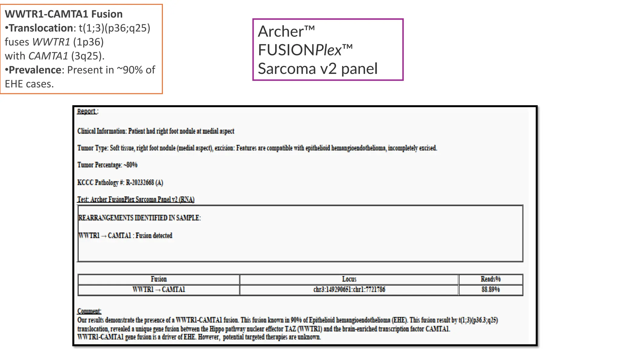 Archer
FUSIONPlex
Sarcoma v2 panel
WWTR1-CAMTA1 Fusion
•Translocation: t(1;3)(p36;q25)
fuses WWTR1 (1p36)
with CAMTA1 (3q25).
•Prevalence: Present in ~90% of
EHE cases.