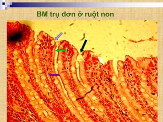 BM trụ đơn ở ruột non
 