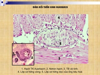 ®¸m rèi thÇn kinh auerbach
1. H¹ch TK Auerbach; 2. N¬ron h¹ch; 3. TB vÖ tinh;
4. Líp c¬ híng vßng; 5. Líp c¬ híng däc cña èng tiªu ho¸
4
5
1
2
2
3
 
