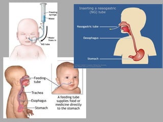 Pemasangan Nasogastric Tube dan Orogastric tube | PDF
