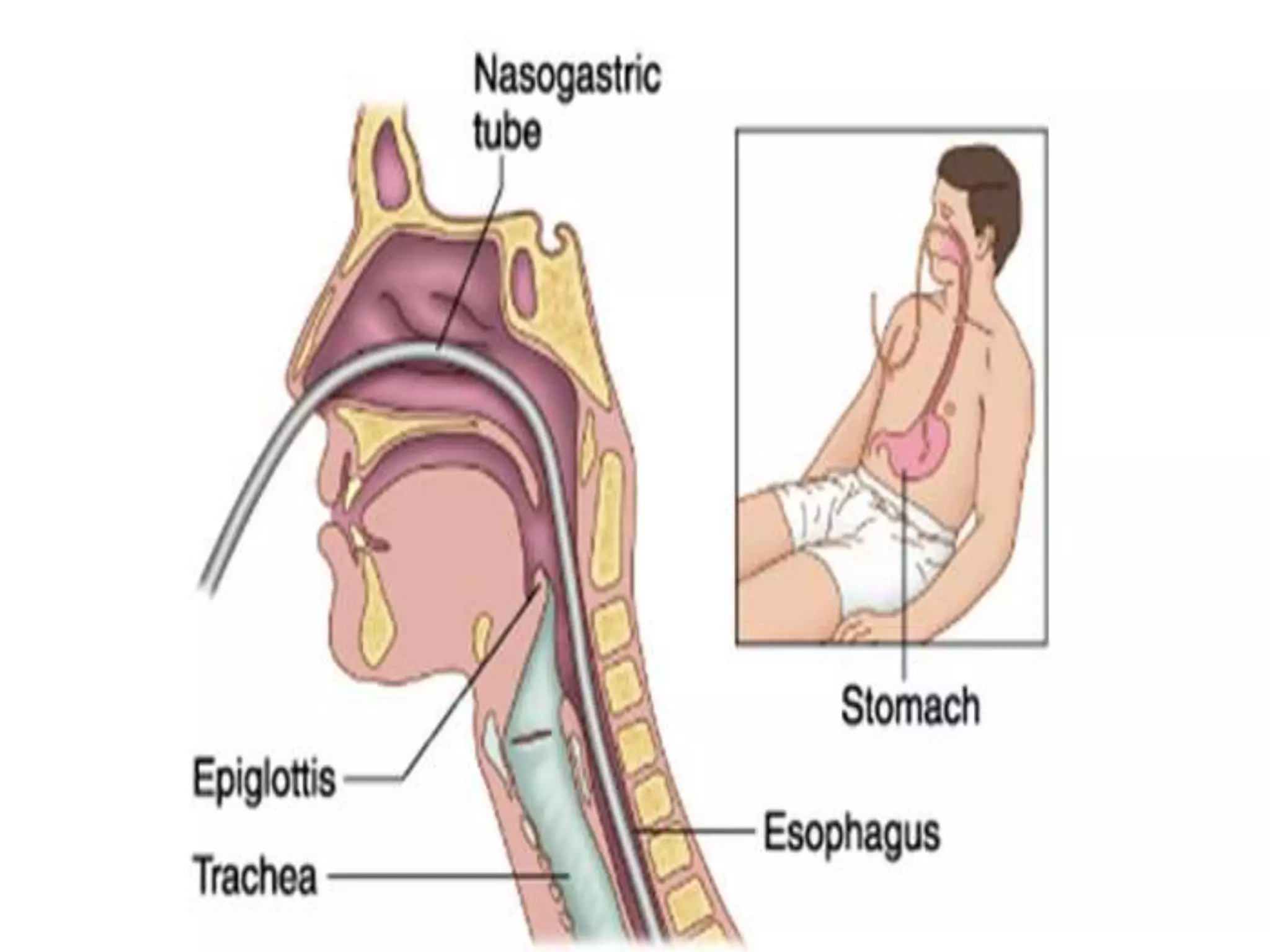 nasogastric-tube-ng-tube-pptx