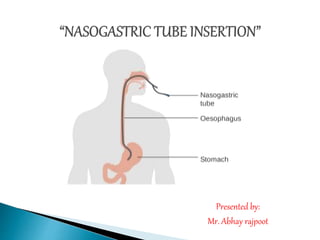 Nasogastric tube (NG tube)