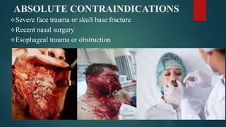 ABSOLUTE CONTRAINDICATIONS
Severe face trauma or skull base fracture
Recent nasal surgery
Esophageal trauma or obstruction
 