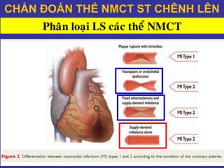 Phaân loaïi LS caùc theå NMCT
CHẨN ĐOÁN THỂ NMCT ST CHÊNH LÊN
 