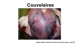 Couvelairee
Nguồn: Williams Obstetrics 24th, Placental Abruption, trang 793
 