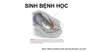 SINH BỆNH HỌC
Nguồn: Williams Obstetrics 24th, Placental Abruption, trang 793
 