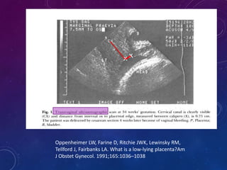 Oppenheimer LW, Farine D, Ritchie JWK, Lewinsky RM,
Tellford J, Fairbanks LA. What is a low-lying placenta?Am
J Obstet Gynecol. 1991;165:1036–1038
 