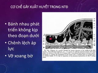 CƠ CHẾ GÂY XUẤT HUYẾT TRONG NTĐ
• Bánh nhau phát
triển không kịp
theo đoạn dưới
• Chênh lệch áp
lực
• Vỡ xoang bờ
 