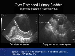 Zemlyn S. The effect of the urinary bladder in obstetrical ultrasound.
Radiology 1987;128:169-175
 