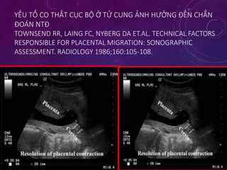 YẾU TỐ CO THẮT CỤC BỘ Ở TỬ CUNG ẢNH HƯỞNG ĐẾN CHẨN
ĐOÁN NTĐ
TOWNSEND RR, LAING FC, NYBERG DA ET.AL. TECHNICAL FACTORS
RESPONSIBLE FOR PLACENTAL MIGRATION: SONOGRAPHIC
ASSESSMENT. RADIOLOGY 1986;160:105-108.
 