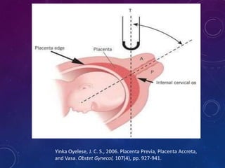 Yinka Oyelese, J. C. S., 2006. Placenta Previa, Placenta Accreta,
and Vasa. Obstet Gynecol, 107(4), pp. 927-941.
 