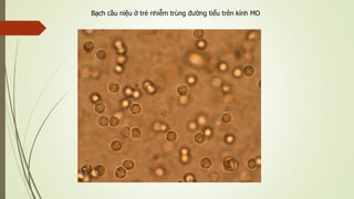 Bạch cầu niệu ở trẻ nhiễm trùng đường tiểu trên kính MO
 