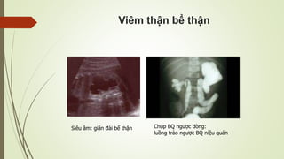 Viêm thận bể thận
Siêu âm: giãn đài bể thận Chụp BQ ngược dòng:
luồng trào ngược BQ niệu quản
 