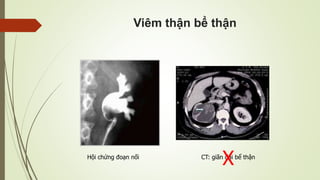 Viêm thận bể thận
CT: giãn đài bể thậnHội chứng đoạn nối
X
 