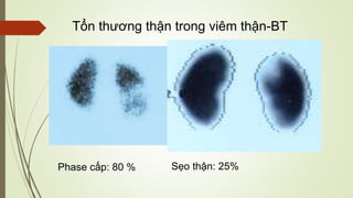 Phase cấp: 80 % Sẹo thận: 25%
Tổn thương thận trong viêm thận-BT
Xạ hình thận DMSA
Hình ảnh chức năng và chất lượng
 