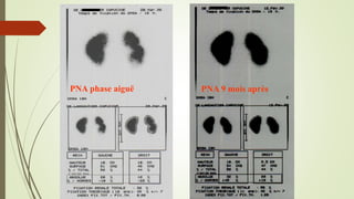 PNA 9 mois aprèsPNA phase aiguë
 