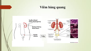 Viêm bàng quang
Thấp
 