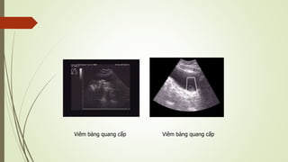 Viêm bàng quang cấp Viêm bàng quang cấp
 