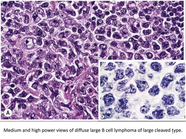 Non hodgkin lymphoma | PPTX