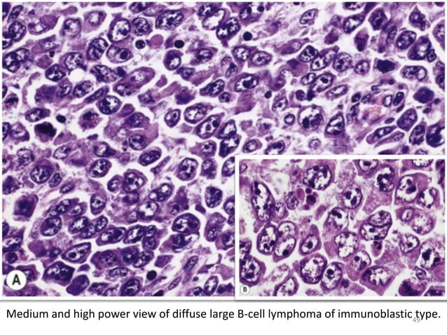 Non hodgkin lymphoma | PPTX