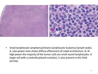 • Small lymphocytic lymphoma/chronic lymphocytic leukemia (lymph node).
A, Low-power view shows diffuse effacement of noda...