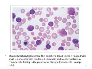• Chronic lymphocytic leukemia. This peripheral blood smear is flooded with
small lymphocytes with condensed chromatin and...