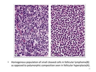 • Homogenous population of small cleaved cells in follicular lymphoma(B)
as opposed to polymorphic composition seen in fol...