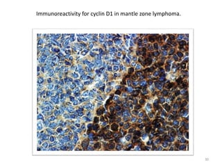 Immunoreactivity for cyclin D1 in mantle zone lymphoma.
30
 