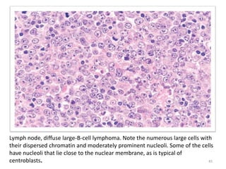 Lymph node, diffuse large-B-cell lymphoma. Note the numerous large cells with
their dispersed chromatin and moderately pro...