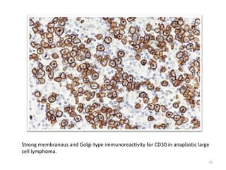 Strong membranous and Golgi-type immunoreactivity for CD30 in anaplastic large
cell lymphoma.
70
 