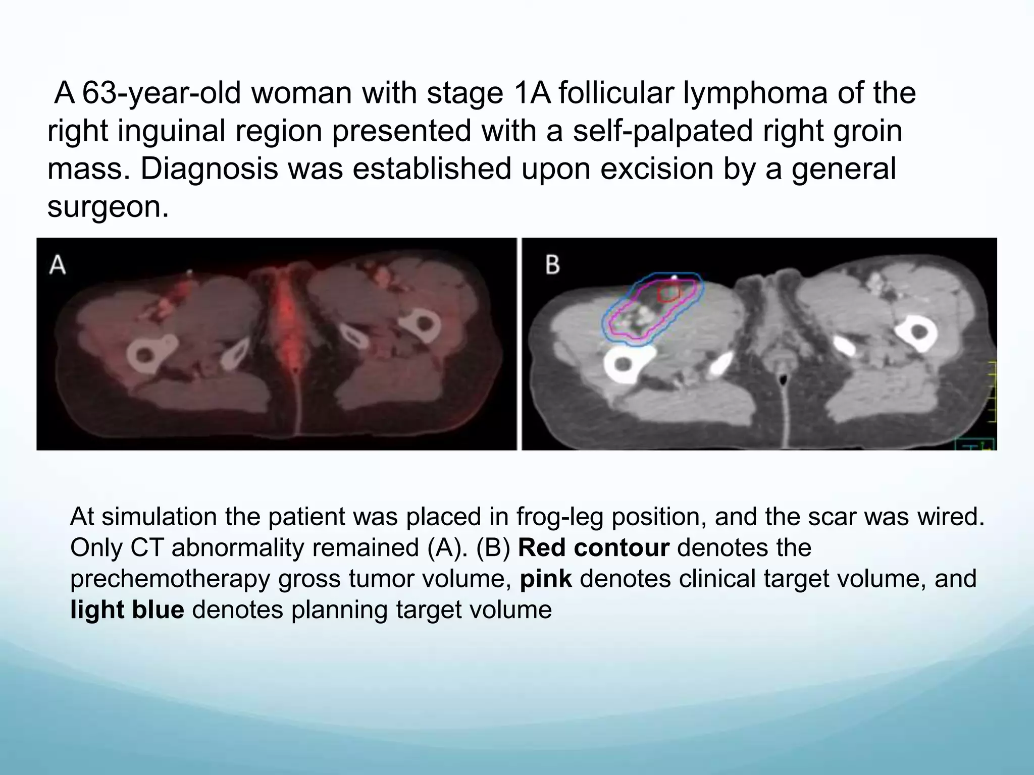 Radiotherapy contouring guideline for non-hodgkin lymphoma | PPTX