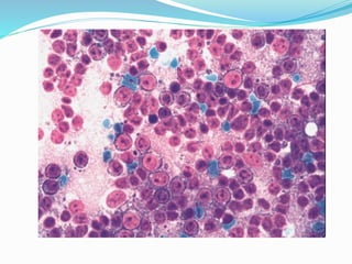 Non Hodgkin Lymphoma, cytology. | PPTX